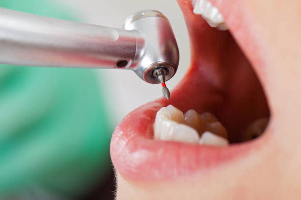 Best Lost Filling or Crown Replacement in Windsor, CA